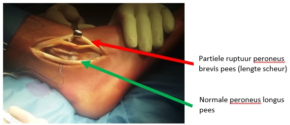 foto peroneus ruptuur (perop)